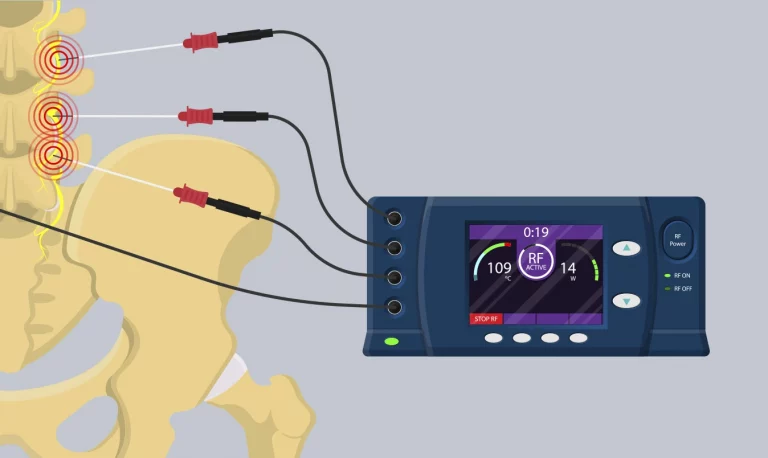 Como a radiofrequência pulsada ajuda no tratamento da dor crônica?