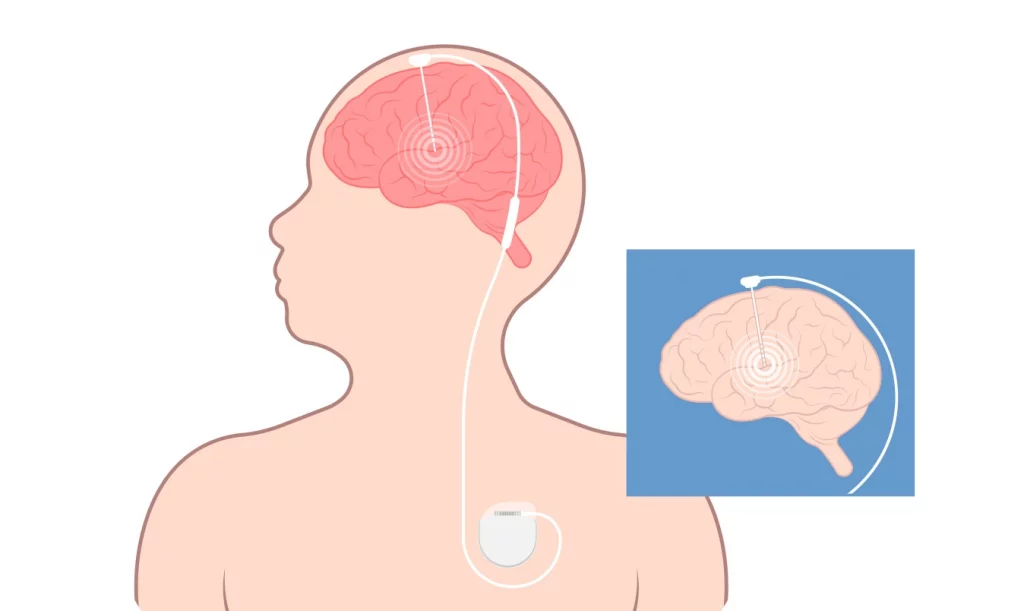 Desenho mostra como o neuroestimulador medular funciona